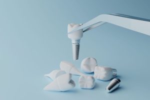implantati