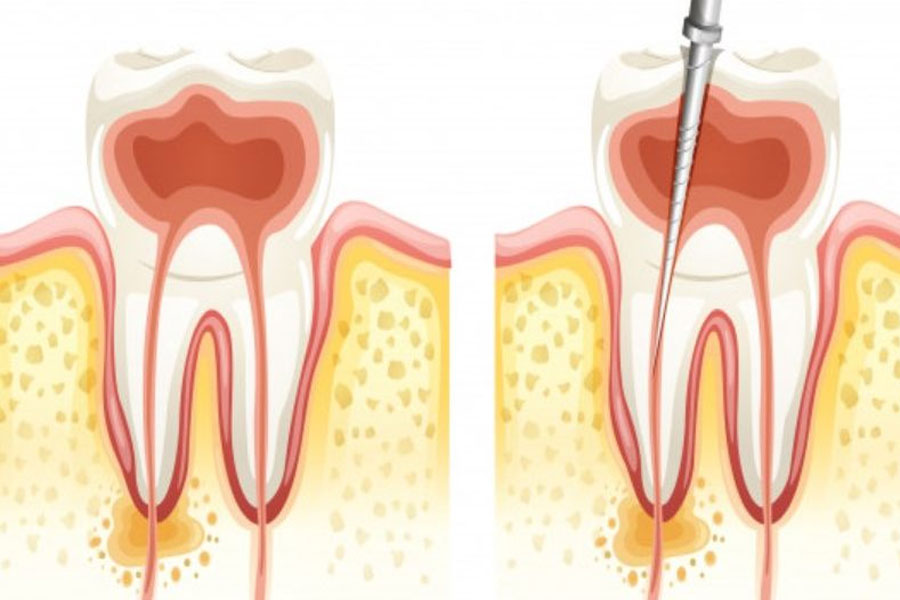 Endodontija zdravljenje