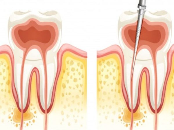 Endodontija zdravljenje
